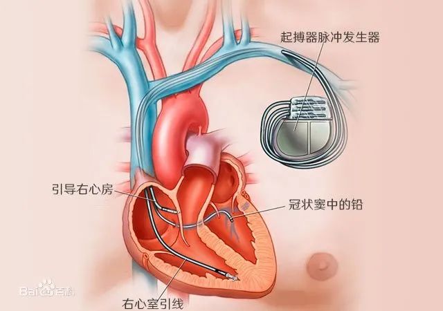 首例心脏双腔起搏器置入术成功实施