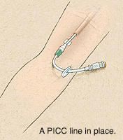 超导下PICC置管术为患者建立安全“静脉通道